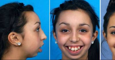 She Couldn't Afford Surgery To Fix Her Deformity Now Look At Her.