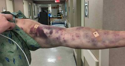 Mystery Bug Bite Baffles Doctors After Man Wakes Up With Terrifying Bruises