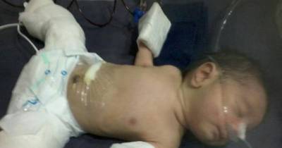 Baby Is Born 'Pregnant' With His Own Twin Brother
