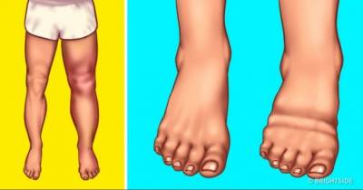 Don&rsquo;t Ignore These Serious Reasons For Swelling