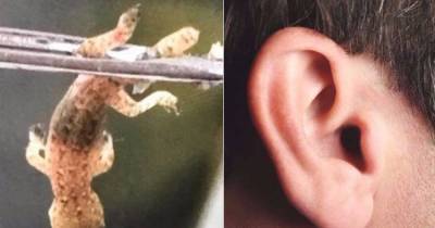 Lizard Found In Man's Ear & Its Tail Is Missing!