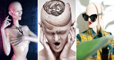 Model With Rare Genetic Disorder Smashes Fashion Stereotypes