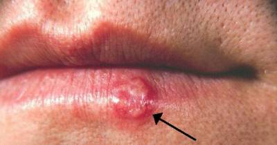How To Get Rid Of An Outbreak Of Herpes Naturally