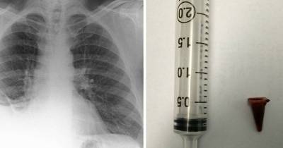 Man&rsquo;s Suspected Lung Tumor Turns Out To Be A Toy He Inhaled 40 Years Ago
