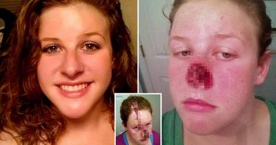 Small Pimple Turned Into Deadly Cancer That Destroyed Women's Face