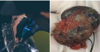 A Woman&rsquo;s &lsquo;Cancer&rsquo; Turns Out To Be A Complication Of Her Old Tattoo