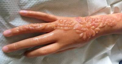 Young Girl Is In Agony When Her Black Henna Tattoo Starts To Painfully Scar Her Arm