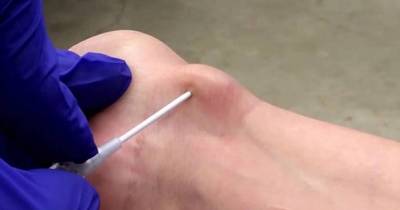 Stomach-Churning Video shows Woman Uses Screwdriver To Pop Wrist Cyst