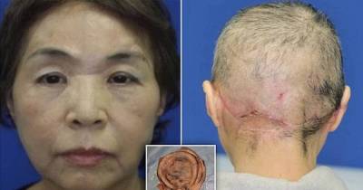 Japanese Woman Is Completely Scalped By A High-Powered Cotton Spinning Machine