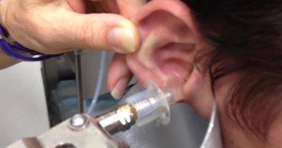 Doctor Took A Look Inside This Mans Ear And Was Shocked To Realize What Was Wrong