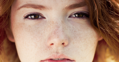 How To Remove Freckles Naturally