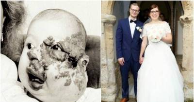 After Years Of Being Teased, A Woman With A Terrible Facial Deformity Has A Fairy Tale Wedding