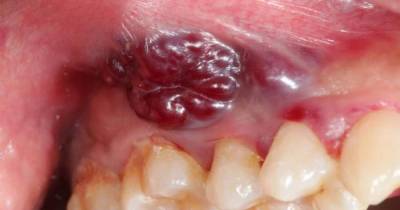 Signs And Symptoms Of Mouth Cancer