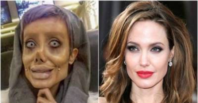 In A Horribly Failed Attempt To Look Like Angelina Jolie, This Iranian Teen Has Had 50 Cosmetic Surgeries!