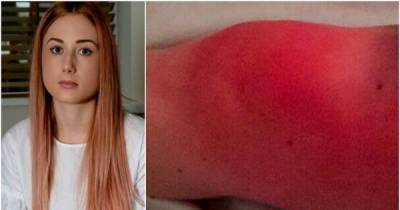 This 23-Year-Old Woman Suffers From A Rare Condition That Forces Her To Sleep Next To A Freezer