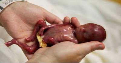 Babies Still Alive After An Abortion? This Shocking Report Shows 27 Babies Being Left To Die After Surviving Abortion.