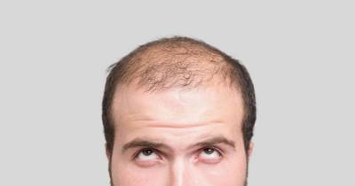 A Cure For Baldness? Scientists Claim To Have Found One.