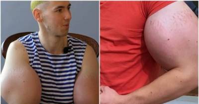 Real Life 'Popeye' May Need To Have His Arms Amputated