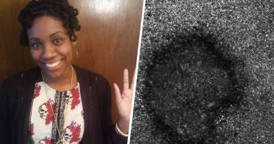 Striking Images Reveal Woman's Eye Damage From Looking At Solar Eclipse Without Protection