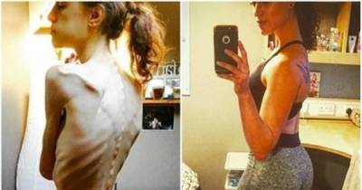 Anorexic Woman Turns To Instagram For Help Recovering From The Disorder