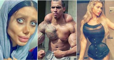 7 Of The Most Extreme Plastic Surgery Fails, You Will Ever See