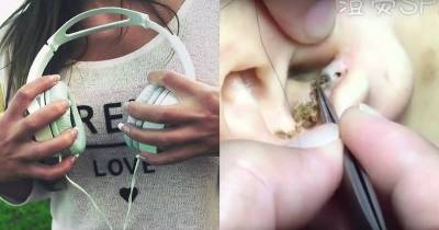 Doctor Warns: Wearing Headphones For Too Long Can Cause Blackheads In The Ear