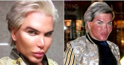 Human Ken Doll Undergoes Bizarre Skin Peeling Procedure In Order To Stay Wrinkle Free Forever.