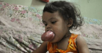 Two-Year-Old Is Slowly Suffocating From Her Tongue, And Her Family Cannot Afford Treatments