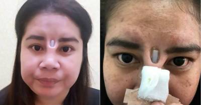 Woman&rsquo;s Botched Nose Job Leaves Her With Horrific Consequences