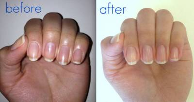 10 Super Easy Methods To Whiten Nails In One Minute
