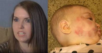 This Couple Was Bewildered After Seeing Injuries On Their Baby's Face And The Truth Behind It Is Horrifying.