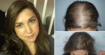 This 46-Year-Old Woman Spent &pound;25,000 On A HAIR TATTOO To Conceal Balding And Get Her Confidence Back!