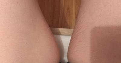 Reddit User Reveals How She Get Rid Of Her Stretch Marks In Just Two Weeks