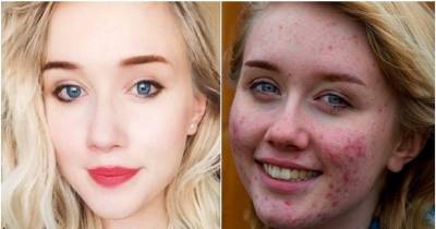 Teen Bullied Over 'Monster Egg' Acne Has The Most Inspiring Message