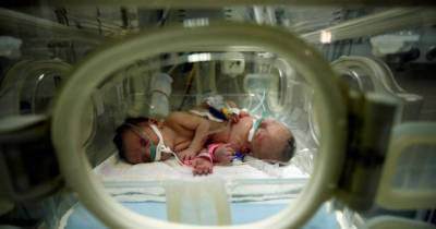Doctors Separate Parasitic Twin Sister From Baby Boy In Saudi-Arabia So He Can Survive