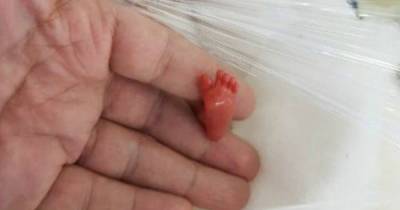 The Smallest Baby To Ever Survive, Born 12 Weeks Prematurely, Weighs A Mere 0.8 Pounds