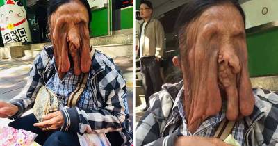Woman With Rare Face-Melting Condition That Caused Her To Go Blind Refuses Surgery