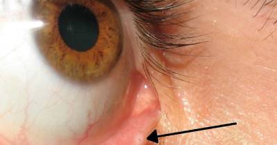 You Probably Never Noticed Tiny Hole On Your Eyelid And Here&rsquo;s What It&rsquo;s For