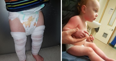 Baby Suffers From Severe Chemical Burns After Mom Leaves Dehumidifier Too Close To The Crib