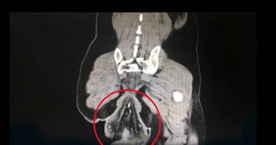 Man's Rectum Falls Out After Spending Too Much Time Sitting On The Toilet