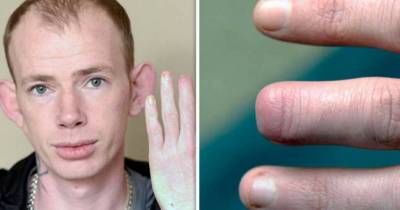 Drunk Man Wakes Up After Boozy Night Out With Top Of Finger Missing And He Has No Idea What Happened