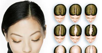 Unhealthy Habits That Lead To Hair Loss In Women