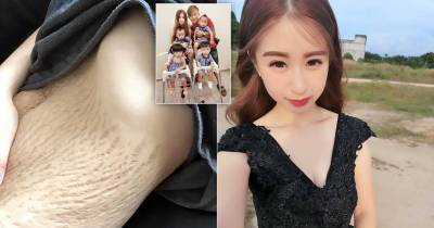 Mother&rsquo;s Stretch Marks Go Viral After Body-Shamers Say She Has &lsquo;Too Many Children&rsquo;