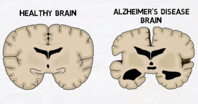 Alzheimer's Disease Warning: You Are At Risk Of Alzheimer&rsquo;s If You&rsquo;re Often Sleepless, Researcher Says