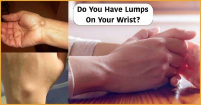 This Is Why Some People Have A Lump On Their Wrist