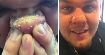 Guy Goes Viral With Intense Blackhead Cure Video And It's Beautiful To Watch