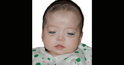 Baby Girl Born With Silver Eyes Finally Gets Adopted By A Loving Family