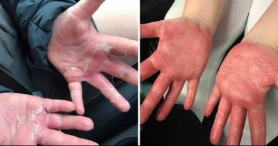 Kids Get Third-Degree Burns While Making A Popular DIY Craft 'Homemade Slime'
