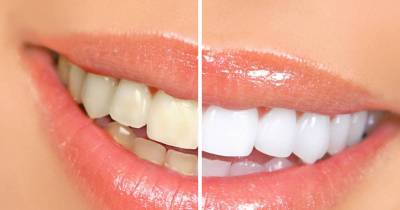 Here Is How You Can Remove Tartar At Home Without Visiting the Dentist