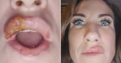 Mom Left In Agony After A Dodgy &pound;180 Fillers Burst In Her Mouth And Her Lip Exploded Five Times